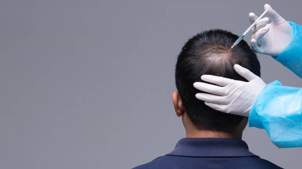 Hair Transplant Turkey Cost Breakdown: Grafts, Techniques, and Care