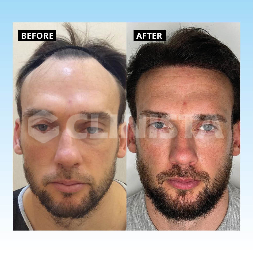 Hair Transplant UK – Your Path to Hair Restoration Success